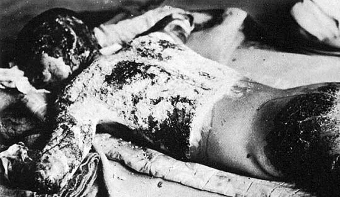 Victim of Atomic Bomb - Onuka Masami - Wikimedia Abbildung von Opfer der Atombombe mit schweren Verletzungen